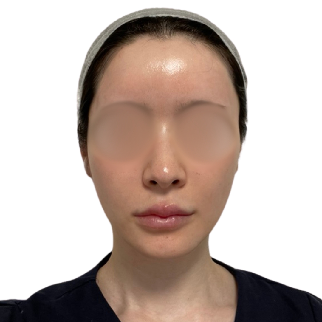 エクソソームフェイシャル